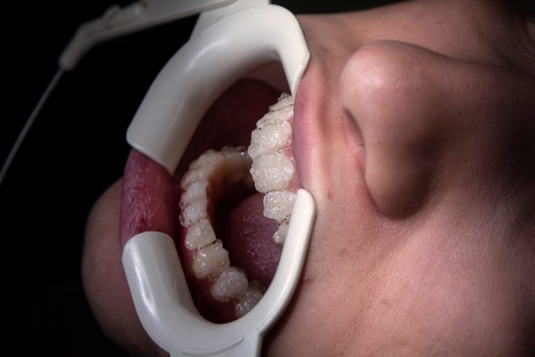 Photo dental calculus