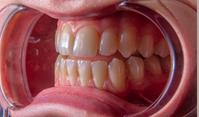 Photo periodontal disease