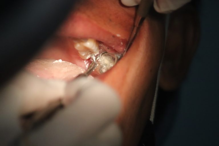 Photo microscopic endodontic treatment